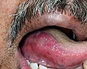 Aphthous ulcer on the tongue