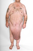 Man with excess skin after weight loss