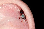 Infected ear piercing