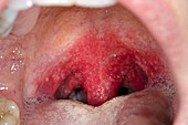 Strep B throat infection