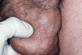 Epididymal cyst in the scrotum