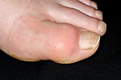Gout in the toe