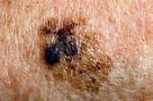 Melanoma skin cancer spread