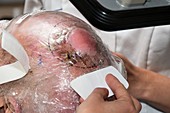 Squamous skin cancer radiotherapy