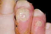 Toe infection in a diabetic