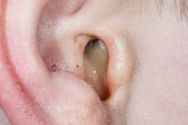 Otitis media with perforated eardrum