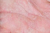 Eczema on the palm of the hand