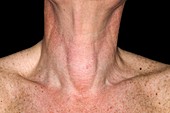 Cystic nodule on the thyroid gland