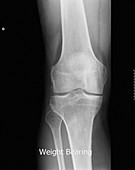 Osteoarthritis in the knee,X-ray