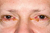 Viral conjunctivitis of the eyes