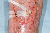 Infected flap laceration on the shin