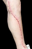 Leg wound after vein removal