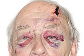 Facial bruising in warfarin patient