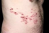 Shingles rash on the torso