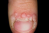 Warts around a fingernail