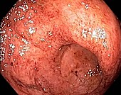 Ulcerative colitis,endoscopic view