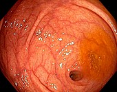 Caecum-appendix aperture,endoscopic view