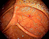Angiodysplasia,endoscopic view