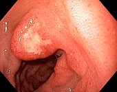 Intestinal ulcer,endoscopic view
