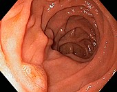 Major duodenal papilla,endoscopic view