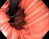 Hiatal hernia,endoscopic view