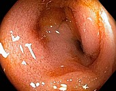 Small intestine,endoscopic view
