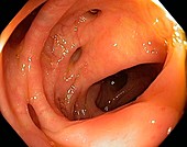 Bowel disease in the colon