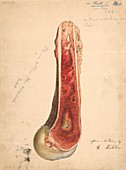 Osteomyelitis after gunshot wound,1860s