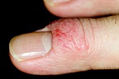 Atopic eczema on the finger