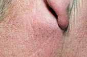 Sebaceous cyst behind the ear