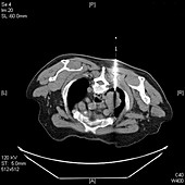 Needle biopsy for lung cancer,CT scan