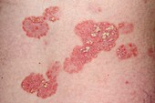 Psoriasis on the skin before lithium