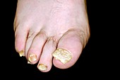Psoriasis of the toenails