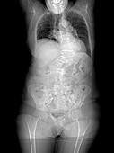 Spinal curvature,X-ray