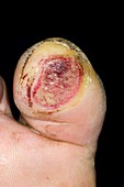Infected blister on the toe
