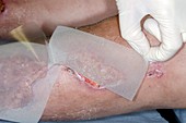 Wound infection after major trauma