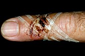 Chainsaw injury to a finger