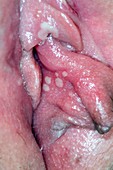 Genital herpes on the vulva