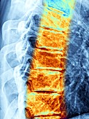 Osteoarthritis of the thoracic spine