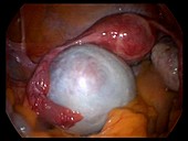Ovarian cyst,endoscope view