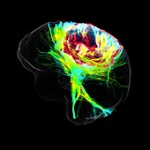 Glioblastoma brain tumour,DTI MRI scan