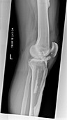 Melorheostosis of the knee,X-ray