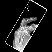Dislocated finger,X-ray