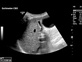 Gallbladder disease,ultrasound scan