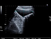 Bladder stones,ultrasound scan
