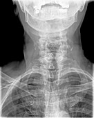 Arthritis of the neck,X-ray
