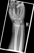 Salter Harris fracture,X-ray