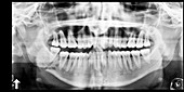 Broken jaw,X-ray