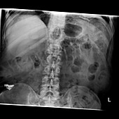 Swallowed key and blades,X-ray