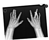 Deformed hands,X-ray